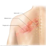 Neuralgia Posherpética: Una Complicación Dolorosa del Herpes Zóster