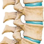 Discopatía: Alteración de los Discos de la Columna Vertebral