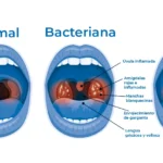 Faringitis Viral