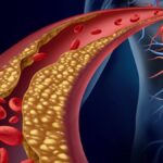 Dislipidemia: Alteración de las Grasas en la Sangre