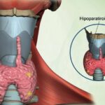 Hipoparatiroidismo: Una Alteración Importante del Metabolismo del Calcio