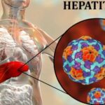 Hepatitis A