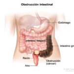 Obstrucción Intestinal: Una Urgencia Médica que Requiere Atención Inmediata