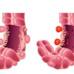 Diverticulosis: qué es, por qué aparece y cómo se puede controlar