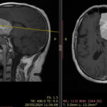 Tumor cerebral: qué es, cuáles son sus síntomas y por qué requiere atención médica oportuna