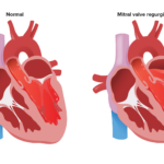 Insuficiencia mitral: una enfermedad de la válvula del corazón que puede afectar la circulación sanguínea