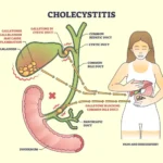 Colecistitis: inflamación de la vesícula biliar, causas, síntomas y tratamiento