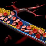 Hipertrigliceridemia: qué es, causas, síntomas, diagnóstico, tratamiento y prevención