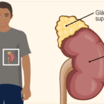 Insuficiencia suprarrenal: causas, síntomas, diagnóstico y tratamiento