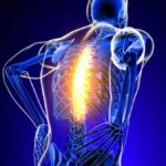 Radiculopatía: causas, síntomas, diagnóstico y tratamiento