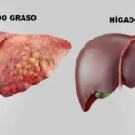 Hígado graso alcohólico: causas, síntomas, diagnóstico, tratamiento y prevención