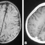 Meningoencefalitis: una inflamación grave del cerebro y las meninges