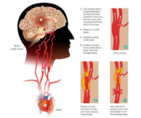 Hemorrhagic stroke.