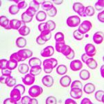 Anemia ferropénica: causas, síntomas, diagnóstico, tratamiento y prevención