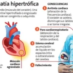 Miocardiopatía hipertrófica: causas, síntomas, diagnóstico, tratamiento y complicaciones