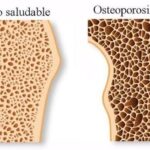 Osteoporosis