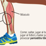 Periostitis: inflamación del periostio, causas, síntomas y tratamiento