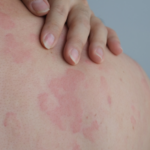 Urticaria: causas, síntomas, diagnóstico y tratamiento