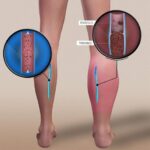 Trombosis venosa profunda: causas, síntomas, diagnóstico y tratamiento