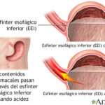 Reflujo gastroesofágico: causas, síntomas, diagnóstico y tratamiento
