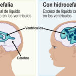 Hidrocefalia: qué es, causas, síntomas, diagnóstico y tratamiento