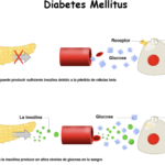 Diabetes tipo 2: causas, síntomas, diagnóstico y tratamiento