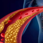 Hipercolesterolemia: causas, síntomas, riesgos y tratamiento