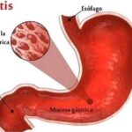 Gastritis: causas, síntomas, diagnóstico, tratamiento y prevención