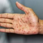 Sífilis: causas, etapas, síntomas y prevención