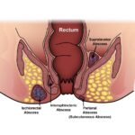 Absceso perianal