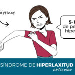 Hiperlaxitud articular