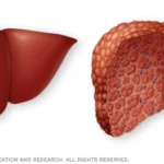 Hemocromatosis: causas, síntomas, diagnóstico y tratamiento