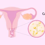 Candidiasis vaginal