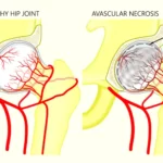Necrosis avascular: causas, síntomas, diagnóstico y tratamiento