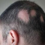 Alopecia areata: causas, síntomas, diagnóstico y tratamiento