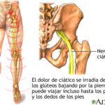 Ciática: causas, síntomas, diagnóstico y tratamiento
