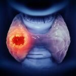Hipertiroidismo: causas, síntomas y tratamiento