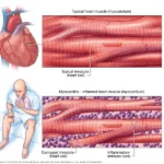 Miocarditis