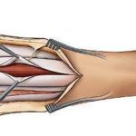 Síndrome compartimental: causas, síntomas y tratamiento