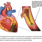 Infarto agudo de miocardio: una emergencia que puede poner en riesgo la vida