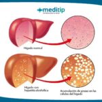 Hepatitis alcohólica: cuando el consumo de alcohol daña gravemente al hígado