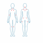 Fibromialgia: una enfermedad caracterizada por dolor generalizado y fatiga
