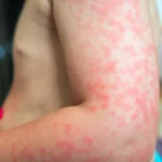 Alergias alimentarias: causas, síntomas, diagnóstico y prevención