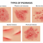 Psoriasis: una enfermedad inflamatoria de la piel que puede afectar más que la apariencia