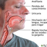 Anafilaxia: una reacción alérgica grave que requiere atención inmediata