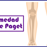 Enfermedad de Paget ósea: una alteración que puede debilitar y deformar los huesos