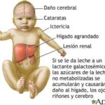 Galactosemia: un trastorno metabólico que requiere detección y tratamiento temprano