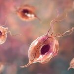 Tricomoniasis