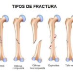 Fracturas