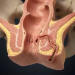 Fístula anal: causas, síntomas, diagnóstico y tratamiento de esta afección
